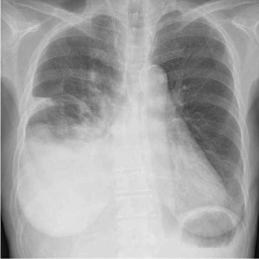 Chest radiograph on postoperative Day 12 after pancreatectomy A chest radiograph showing a right-sided sub-massive pleural effusion.