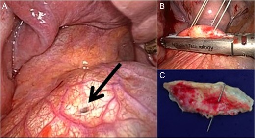 Operative findings during thoracic surgery. (A) Operative findings show a diaphragmatic fistula (arrow). (B) The fistula is closed with a surgical stapler. (C) The resected diaphragm shows a pleuroperitoneal communication. (Fibrosis was observed; however, no other pathological abnormality was identified in the excised diaphragmatic tissue.)