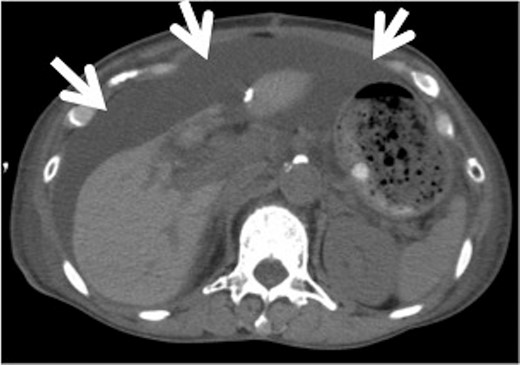 Abdominal computed tomography (CT) after thoracic surgery. Abdominal CT after thoracic surgery shows sub-massive ascites (arrows).
