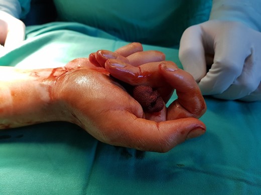Preoperative.