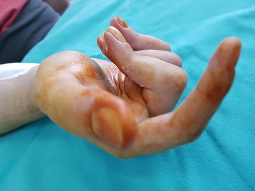Postoperative.