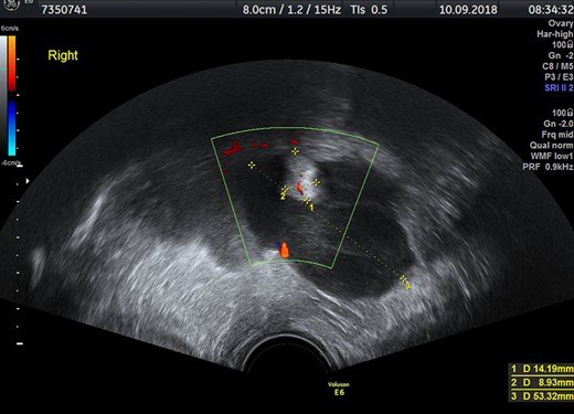 Transvaginal ultrasound with inhomogenous mass in the right part of the small pelvis.
