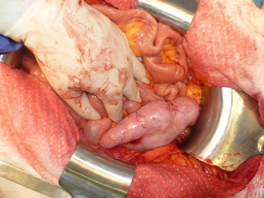 Thickened appendix and mesoappendix with porcelain-like suface.