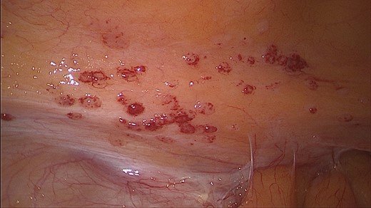 Peritoneal nodules seen in diagnostic laparoscopy.