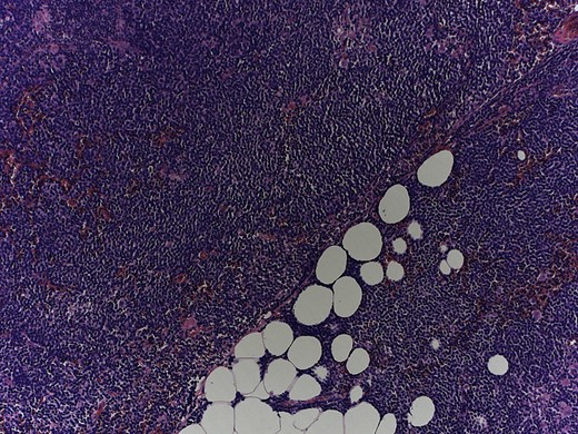 Magnification 10×, hematoxylin and eosin staining shows a monomorphic lymphoid population with a diffuse growth pattern.