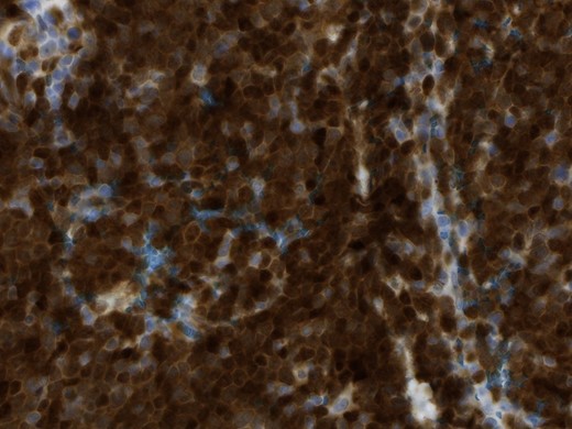 Magnification 40×, the immunohistochemical staining shows strong diffuse nuclear expression of Cyclin D1 (>95% of all mantle cell lymphoma including CD5-negative cases).