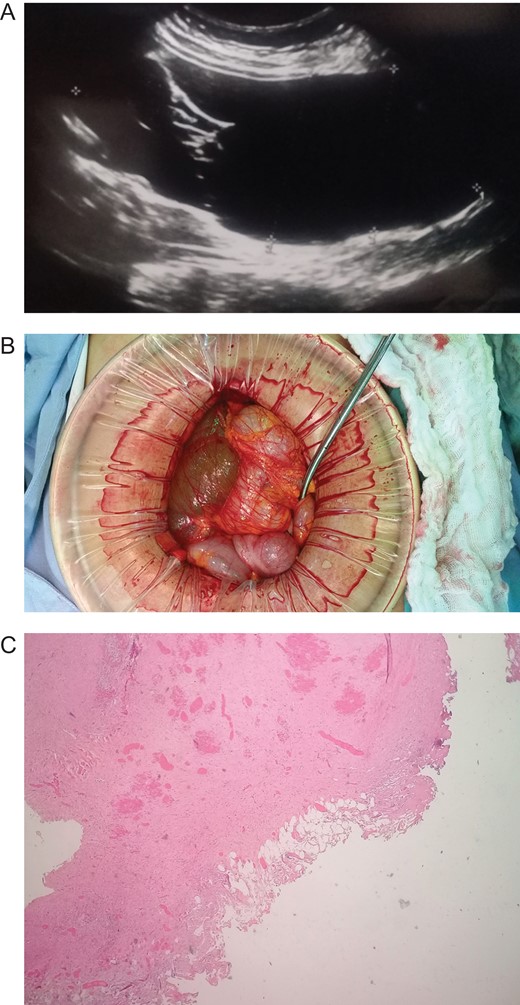 (A) Echography revealing a 15 × 15 cm2 septate thin-walled giant cystic mass. (B) Giant cyst was near the root of the small bowel mesentery. (C) Pathology, cyst wall, without areas of malignancy. (Hematoxylin and eosin staining 10×).