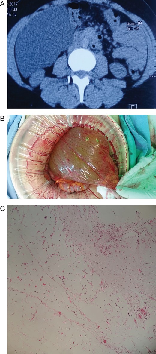 (A) CT revealing a well-defined 19.7 × 15 × 10 cm3 giant cyst. (B) Giant cyst surrounded by the bowel. (C) Pathology, cyst wall covered by adipose tissue. (Hematoxylin and eosin staining 40×.)