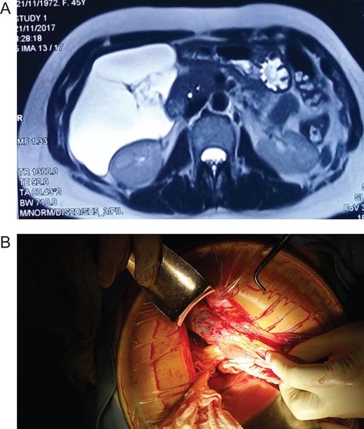 (A) MRI, showing a giant cyst without communication with the bile duct or pancreas. (B) Mesenteric cyst adhesions to the gallbladder and liver.
