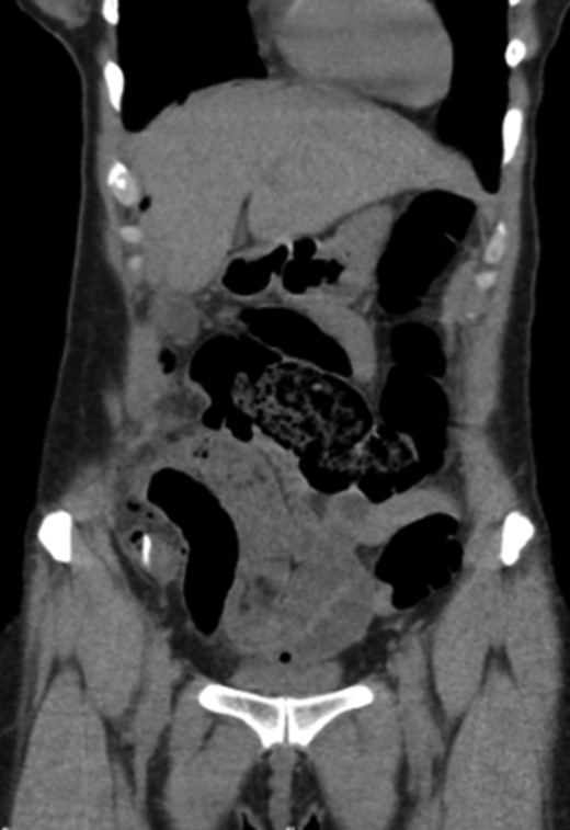 CT scan evidencing a foreign body in distal ileum with intraperitoneal free air.