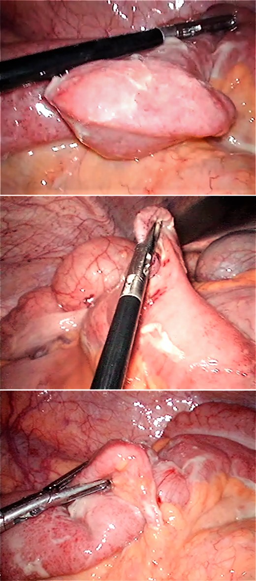 Perforated Meckel´s diverticulum by a foreign body in-situ (fish bone).