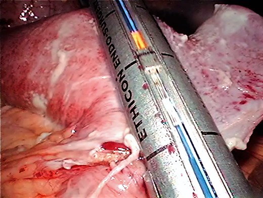Stapled diverticulectomy.