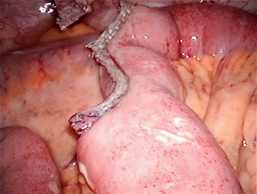 Staple line after resection.