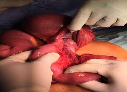 Intraoperative finding of small bowel intussusception.