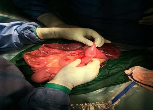 Small bowel intussusception after reduction.