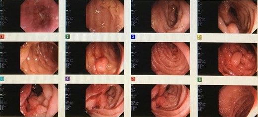 Endoscopy finding of multiple duodenal polyps.