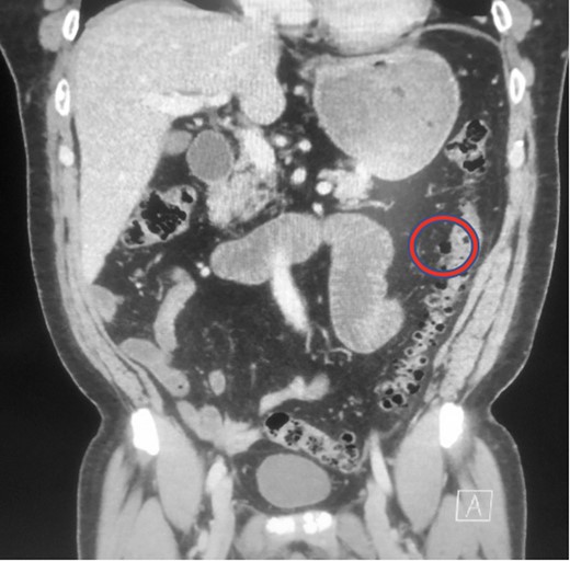 Abdominal CT demonstrating collection of air and debris. Area of interest is circled in red.