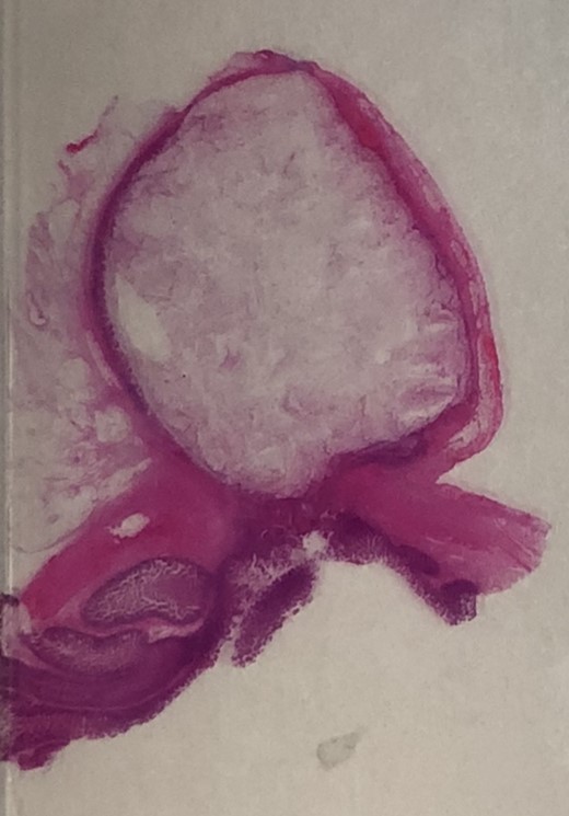 H&E 1× image of the small bowel diverticulum (top of image) pouching out from the bowel lumen (bottom of image).