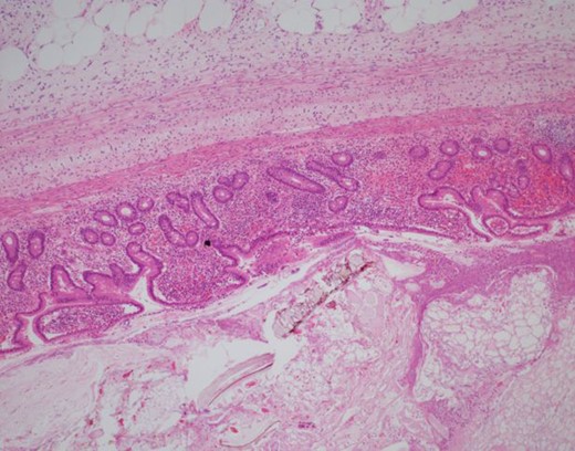 H&E 40× image of the mucosal lining of the diverticulum and ingested food debris in the lumen. Only the mucosa is present in the wall, which classifies this as an acquired rather than congenital.