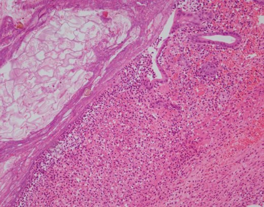 H&E 100× image demonstrating an area of ulceration in the diverticulum with fibrinopurulent exudates occupying most of the right side of the image and food debris in the lumen at the upper left.