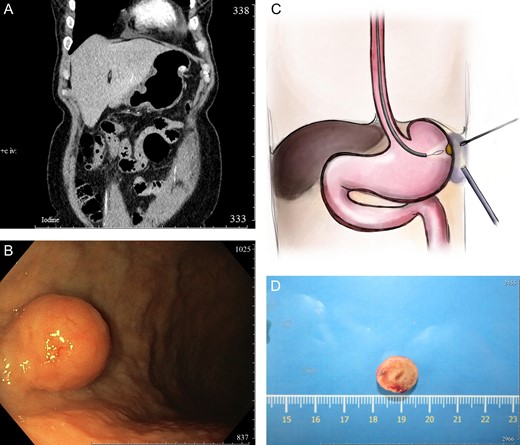 (А) Contrasted abdominal CT, frontal scan, arterial phase. The narrow shows the NET growth all layers of the stomach; (B) intraoperative endoscopic picture; (С) scheme of the procedure; and (D) specimen.