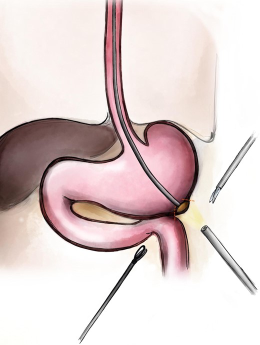 Scheme of the procedure: the endoscope makes the laparolifting to mark the borders of the future resection.