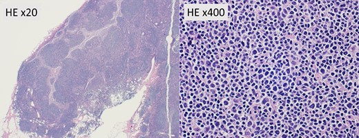 Hematoxylin and eosin staining (HE) of intraoperative frozen sections of lymph nodes showing large follicles without evidence of metastasis. Magnification, ×20, ×400.