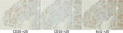 Immunohistochemistry of sampled lymph nodes showing positivity for CD20, CD10, and Bcl-2 protein. Magnification, ×20.