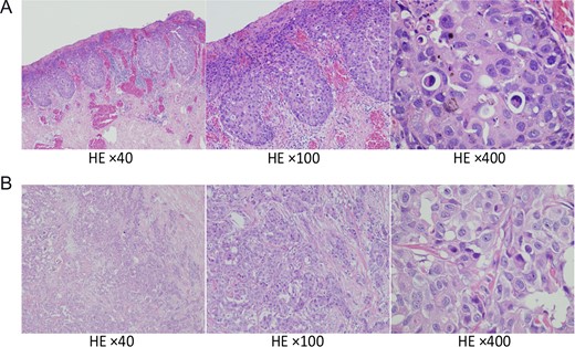 Hematoxylin and eosin staining of surgical specimens. (A) Specimens of the nipple showing Paget’s disease and (B) Specimens of the tumor in the left lateral breast showing scirrhous carcinoma. Magnification, ×40, ×100, ×400.