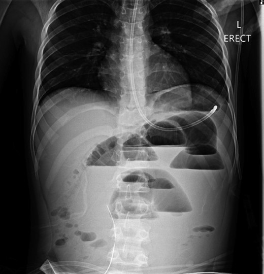 Erect chest radiograph on postoperative day 2 suggestive of small bowel ileus.