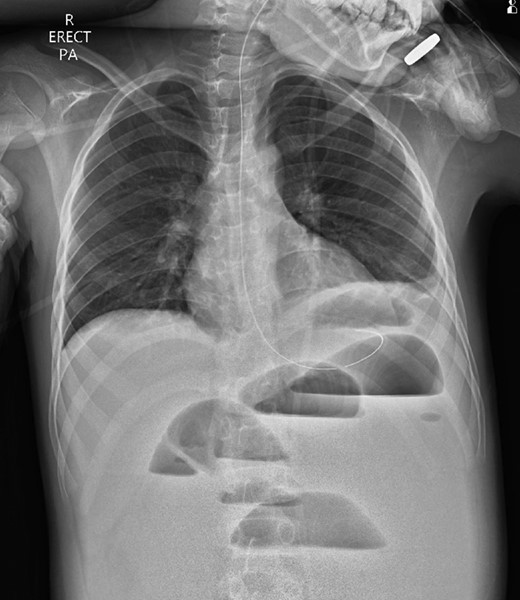 Erect chest radiograph on day 5 more consistent with small bowel obstruction.