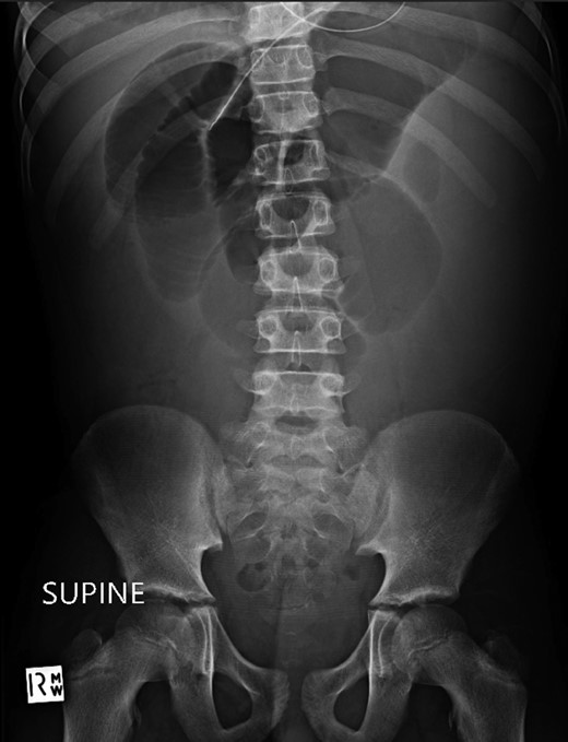Supine abdominal radiograph on day 5 showing dilated small bowel loops with no bowel gas evident in the colon.
