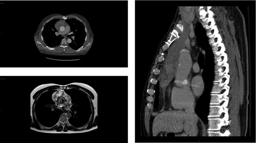 Imaging showing anterior mediastinal mass 4 years after a type A aortic dissection. Axial (top left) and sagittal (right) chest CT images of the large (6.0 × 3.2 × 12.8 cm3) heterogeneous collection in the right prevascular space anterior to the ascending aorta initially concerning for a rupture but contained hematoma. MRI depicting the same heterogenous soft tissue mass (bottom left). Of note, no mass was detected on the chest CT scan performed 4 years prior (not shown).