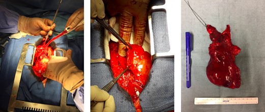 Intraoperative images showing location of lesion and final resected specimen. Intraoperatively, the mass was found to be overlying but densely adherent to the aorta (left). The mass was completely resected with an intact capsule; lesion in situ (middle) and resected specimen (right).