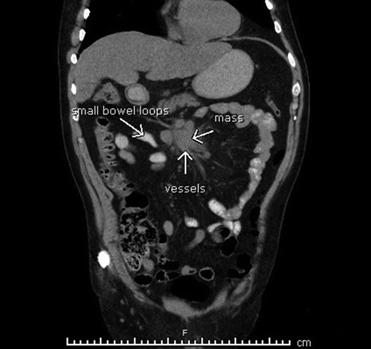 Mesenteric lymphadenopathy found on computerized tomography.