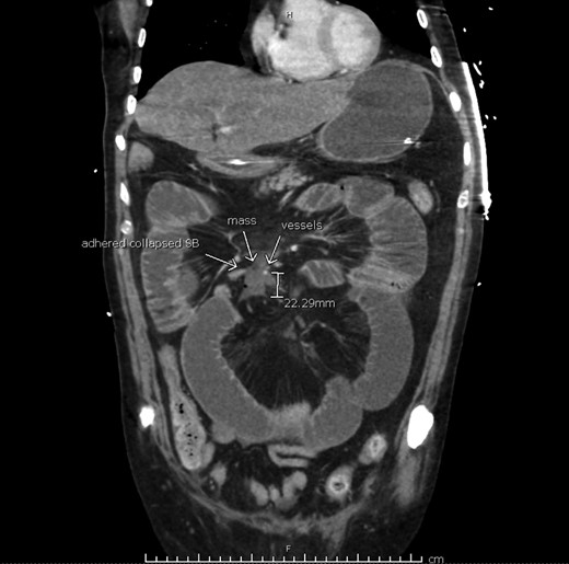 Computerized tomography suggesting tumor recurrence and small bowel obstruction.