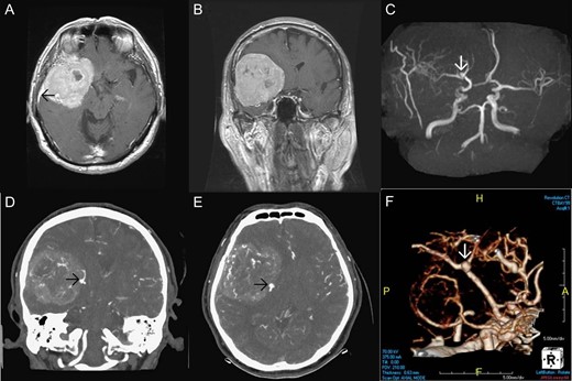 Pre-operative imaging. Axial T1 weighted image post gadolinium enhancement (A), coronal T1 weighted image post gadolinium enhancement (B) showing a large extraaxial well-circumscribed mass lesion in the right frontal–temporal convexity, abutting the skull bone with good enhancement and dural tail sign (black arrow in Fig. 1A). MRA (C) showing a suspicious small aneurysm in bifurcation of the right middle cerebral artery (white arrow). CTA of brain coronal view (D), axial view (E), 3D reconstruction (F) showing a wide-based saccular aneurysm in bifurcation of the right middle cerebral artery abutting the tumor with dome tilting laterally, anteriorly and inferiorly.