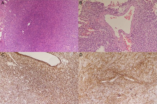 Histology of the specimen. Tumor HE stain 100× (A) showing spindle cells in fascicular and storiform architecture with collagen fibers invested in between tumor cells, and round oval nuclei in haphazard pattern with limited intervening stroma. Tumor HE stain 200× (B) showing staghorn vessel. Tumor STAT6 stain (C) and CD34 stain (D) showing positive staining.