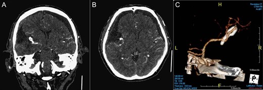 Post-operative imaging. CTA of brain coronal view (A), axial view (B), 3D reconstruction (C) showing the complete removal of the tumor and the complete surgical clipping of the aneurysm without residual lesions.