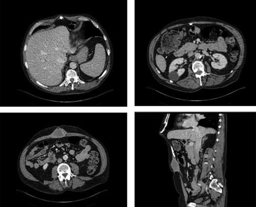 CT of the abdomen demonstrating anterior abdominal wall collection and the abnormal calcification. It revealed an ovoid collection within the anterior abdominal wall in the midline inferior to the mesh measuring 3.3 × 5.1 × 5.4 cm. In addition, it showed the abnormal calcification below the xiphoid process.