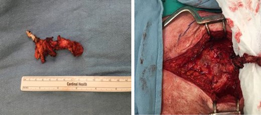 Intraoperative finding of the abnormal calcified tissue below the xiphoid process.