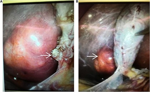 (A, B) The right liver lobe mass (nodular, soft, fatty appearance) compressing cystic duct (arrows), seen during laparoscopic cholecystectomy.