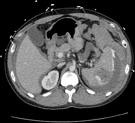 CT abdomen with intravenous contrast, axial view, demonstrating intrasplenic pseudoaneurysm with active arterial extravasation.