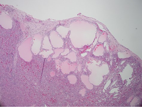 Hematoxylin and eosin stain photomicrographs from splenectomy consistent with splenic lymphangioma with 10x magnification.