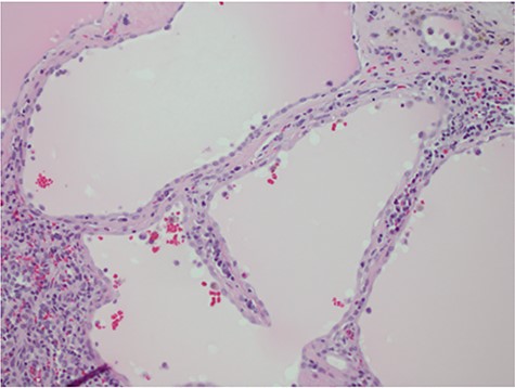 Hematoxylin and eosin stain photomicrographs from splenectomy consistent with splenic lymphangioma with 40x magnification.