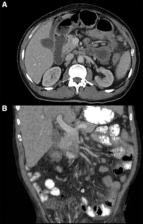 CT thorax abdomen, axial (A) and coronal (B) images. (A) Intra-abdominal free air and fluid, perihepatic, mesenteric and pelvic. (B) Mesenterial lymphadenopathy.