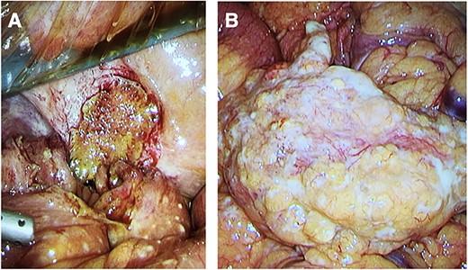 Intra-operative photos. (A) Site of the larger jejunal perforation, contained due to adhesion to the peritoneum. (B) Large studded white bowel mass with numerous peritoneal and omental depositions.