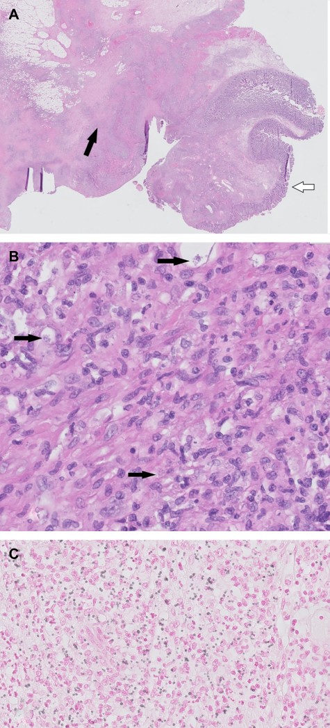 Histopathological images. (A) H&E overview duodenal resection specimen. White arrow: normal duodenal mucosa. Black arrow: inflammation with fibrosis and necrosis. (B) H&E 400×. Black arrows: histoplasmosis. (C) H&E 400×, Grocott staining histoplasmosis.