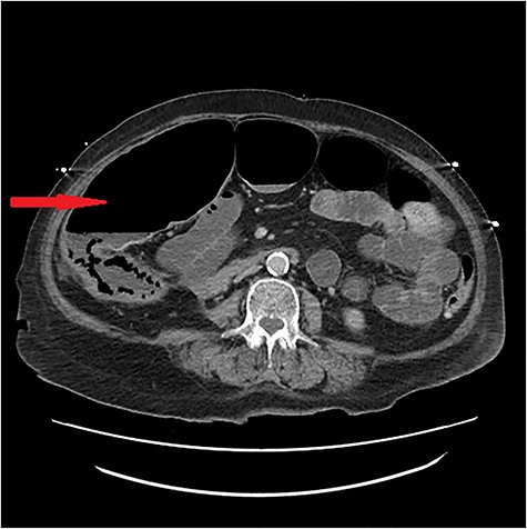 CT scan image showing dilated bowel loops.