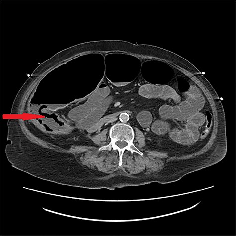 CT scan image showing pneumatosis.